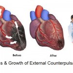 Expanding Access and Growth of External Counterpulsation (ECP and EECP) Therapy Worldwide